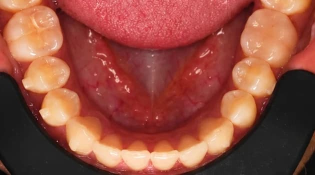 Crowding teeth, after treatment