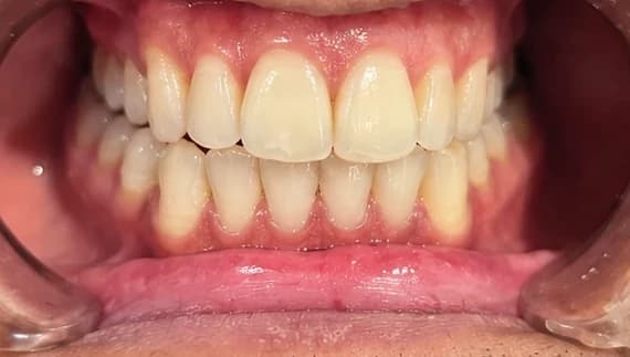 Crowding teeth, after treatment