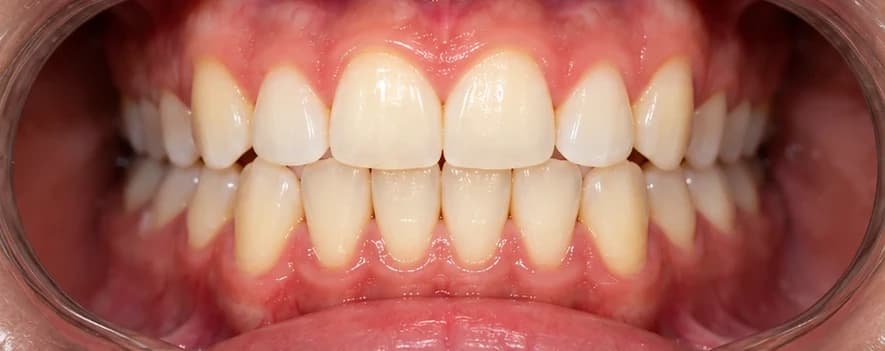 Gaps between teeth, after treatment