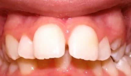Overbite, before treatment