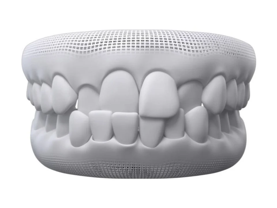 3D model of teeth showing crossbite