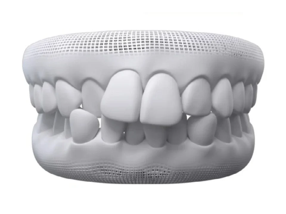 3D model of teeth showing crowded teeth