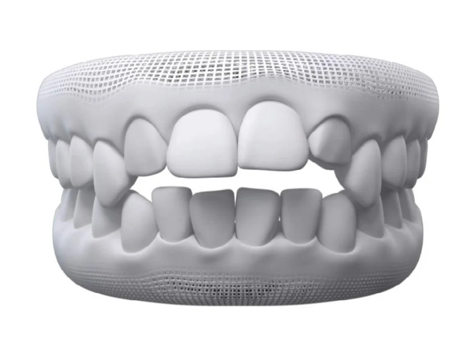 3D model of teeth showing open bite