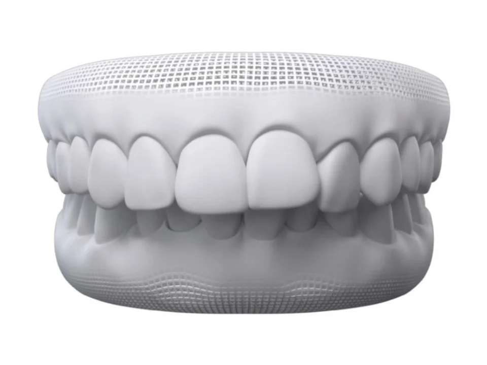 3D model of teeth showing overbite