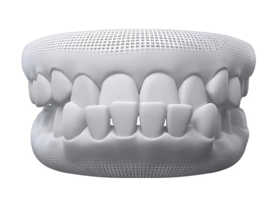 3D model of teeth showing underbite